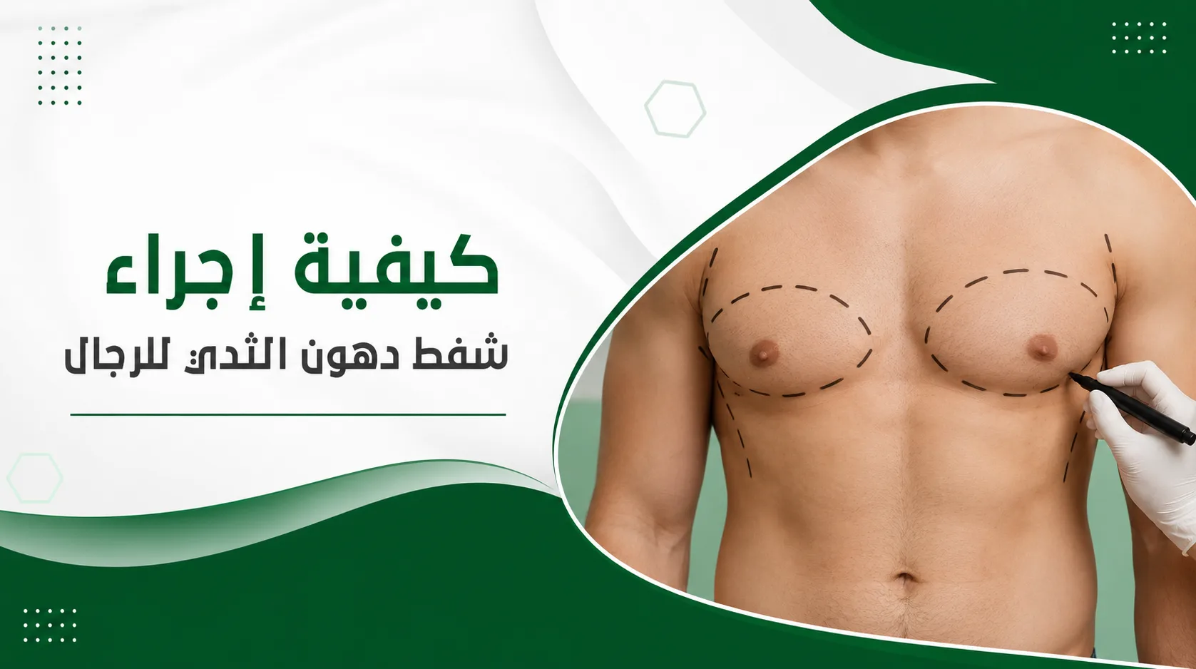 كيفية إجراء شفط دهون الثدي للرجال